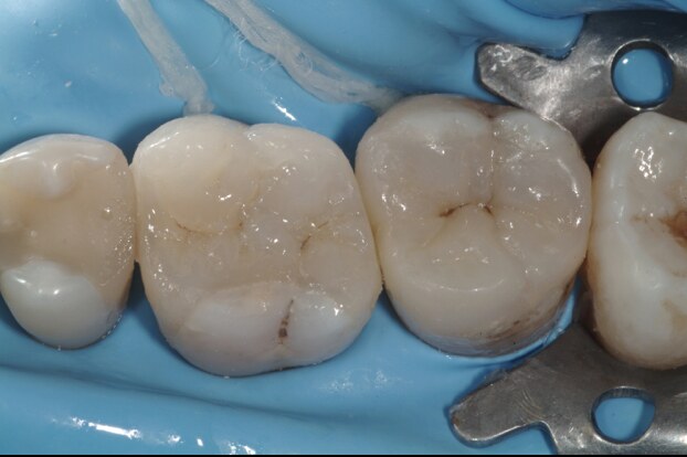 Finished indirect restoration, after treatment