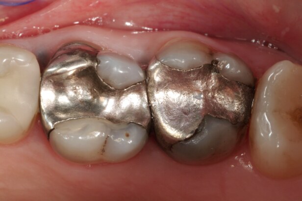 Failing amalgam restoration, before treatment
